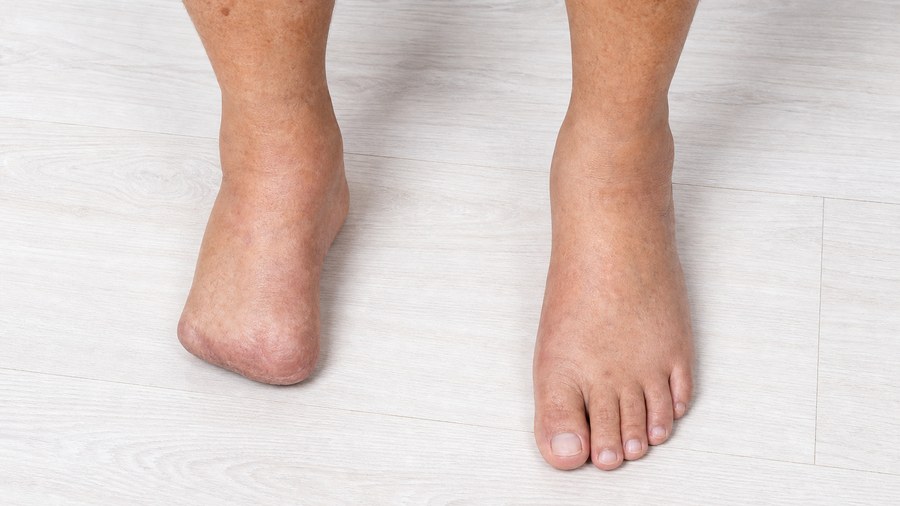 Partial Foot Amputation