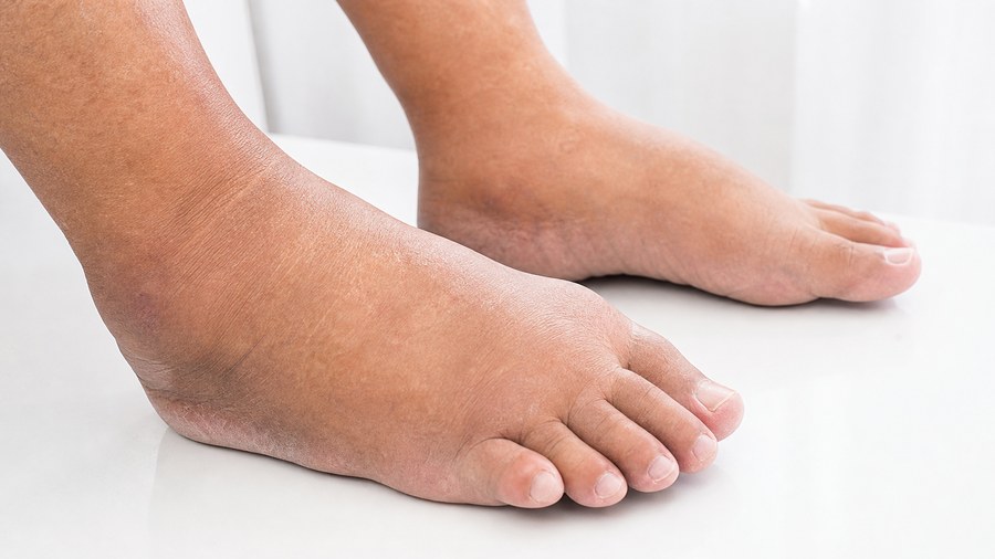 Charcot Foot