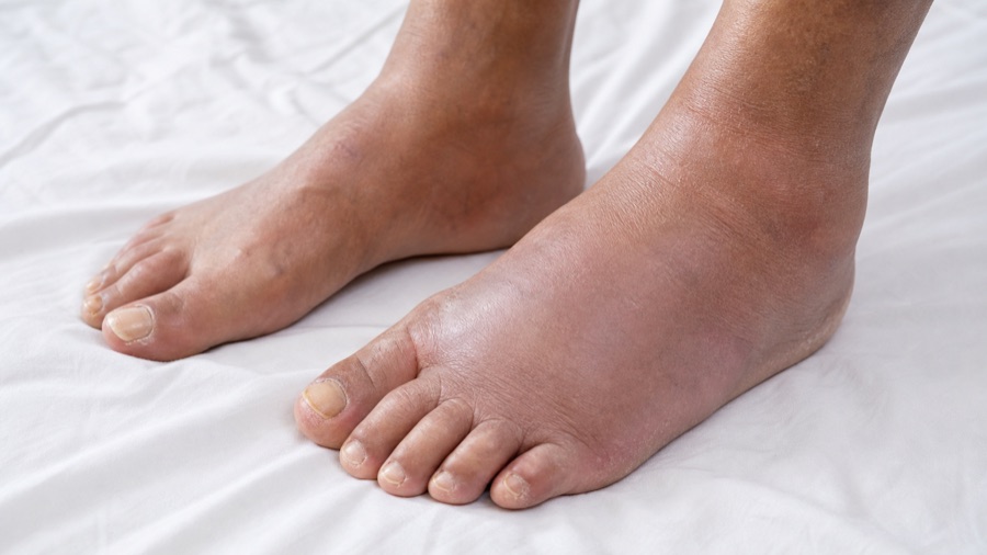 Charcot Foot