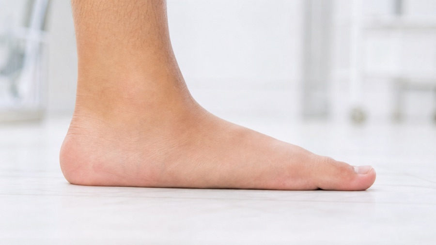 Flat Feet