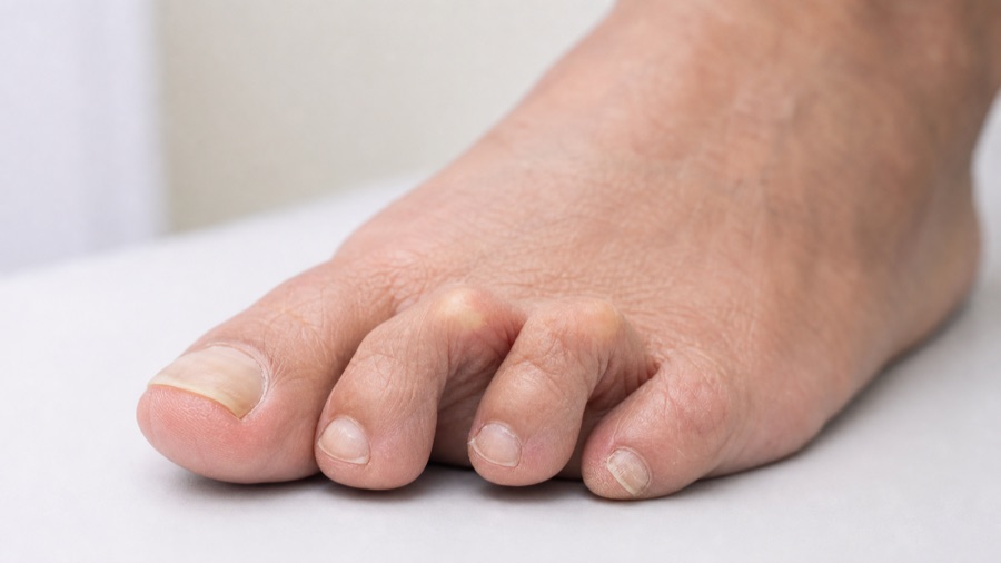 Hammer Toes